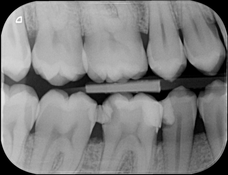 Afbeelding 1. Een blik op de bitewing en de apicale röntgenopname.