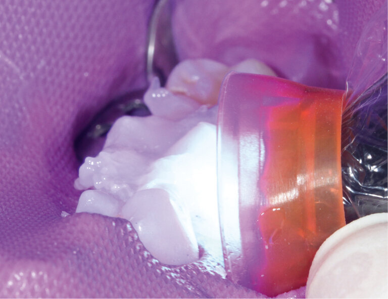 Fig.14: Light-curing all segments for 10 s per mm of composite using a Bluephase Style