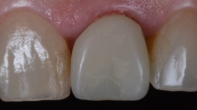 Carico immediato dell’impianto e restauro di incisivo fratturato