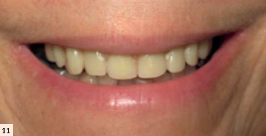 Mise en charge du bridge provisoire transvissé le jour de l’intervention.