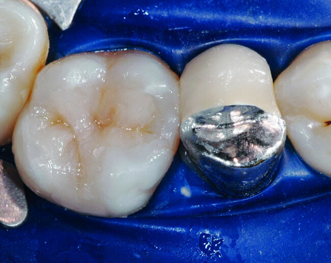  Fig.13 : Vue occlusale de la restauration composite. 