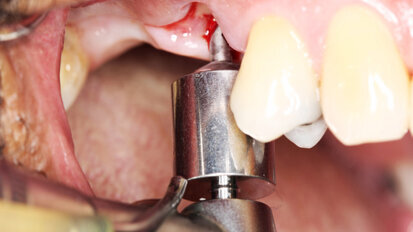 Dva v jednom: Pilotní vrták a chirurgická šablona