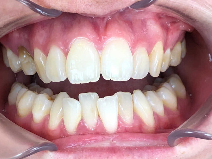 Photo de face début de traitement (Copyright- Dr Edouard Negre)