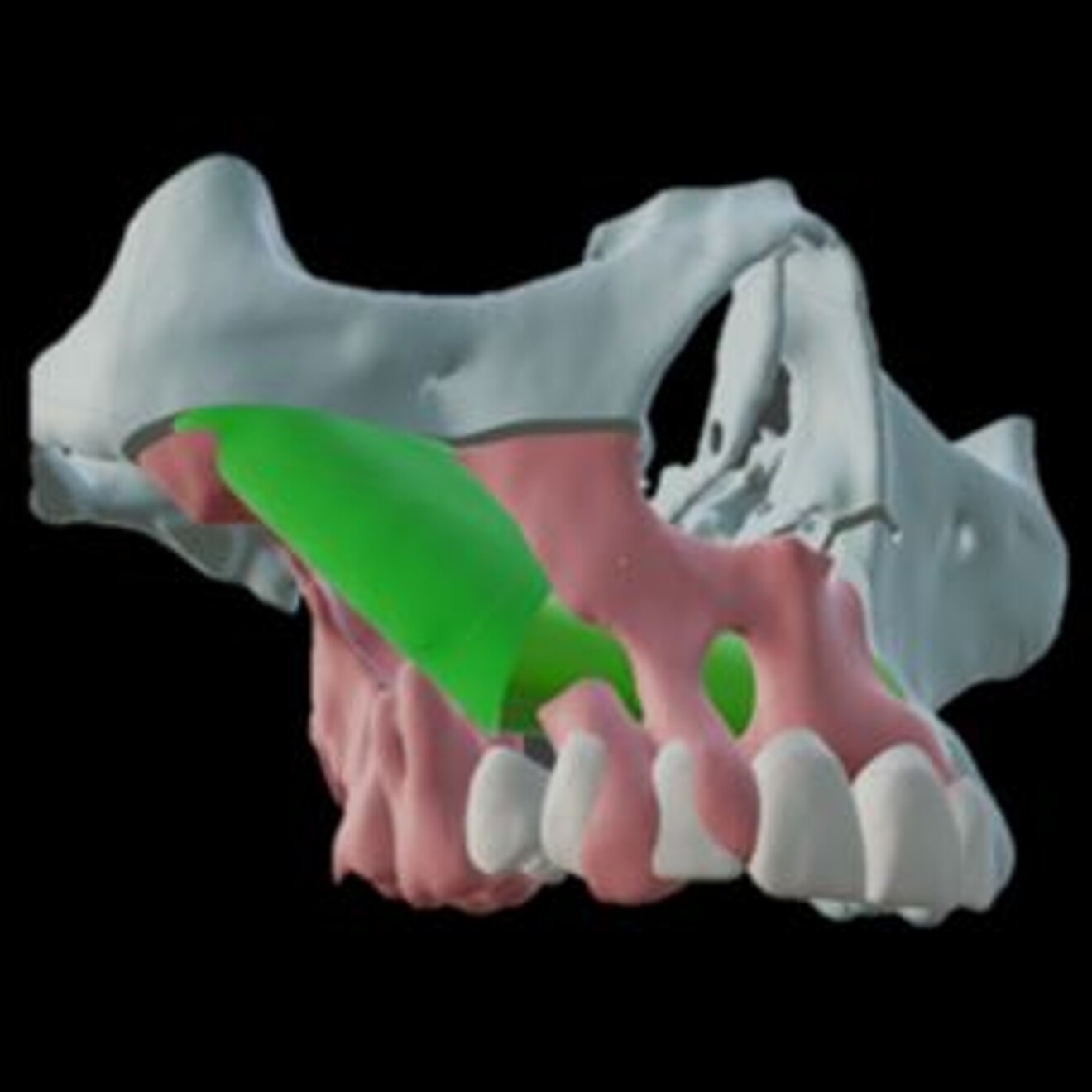 Fig. 3: Prosthetic-driven reconstruction.