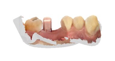 Digital peri-implant tissue healing