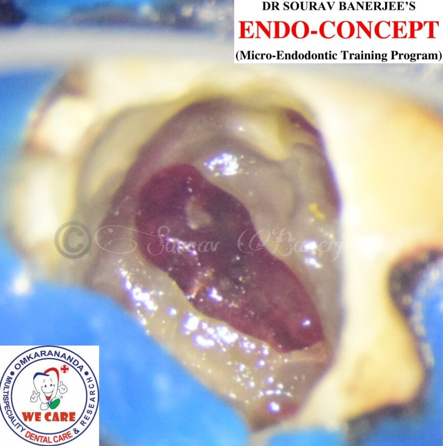 Fig. 4: Intra-op image of tooth #46 captured under the dental operating microscope at 16× magnification showing the clean perforation defect prior to its sealing with MTA and PRF.