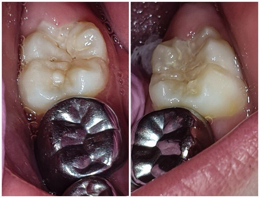 Afbeelding 7: De eerste blijvende molaren in de onderkaak met zeer diepe, complexe ontkalkte fissuren. Hier is sealen geïndiceerd.