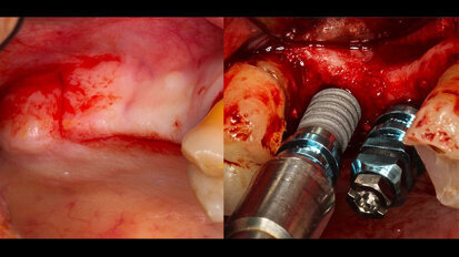 Cirugía implantológica avanzada