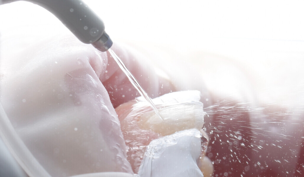 Fig. 6: Thorough rinsing to remove the etchant from the surface.