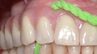 Deplaquing con un filo dotato di passafilo: esperienza clinica