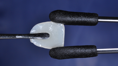 Front-tooth restoration to go