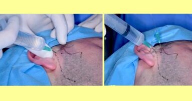 Tratamiento quirúrgico mínimamente invasivo de la ATM (3)