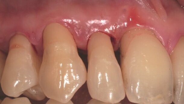 Zapobieganie głębokim chorobom przyzębia dzięki zastosowaniu lasera Er:YAG