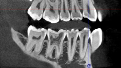 3D technologie v diagnostice a léčbě endodontických onemocnění