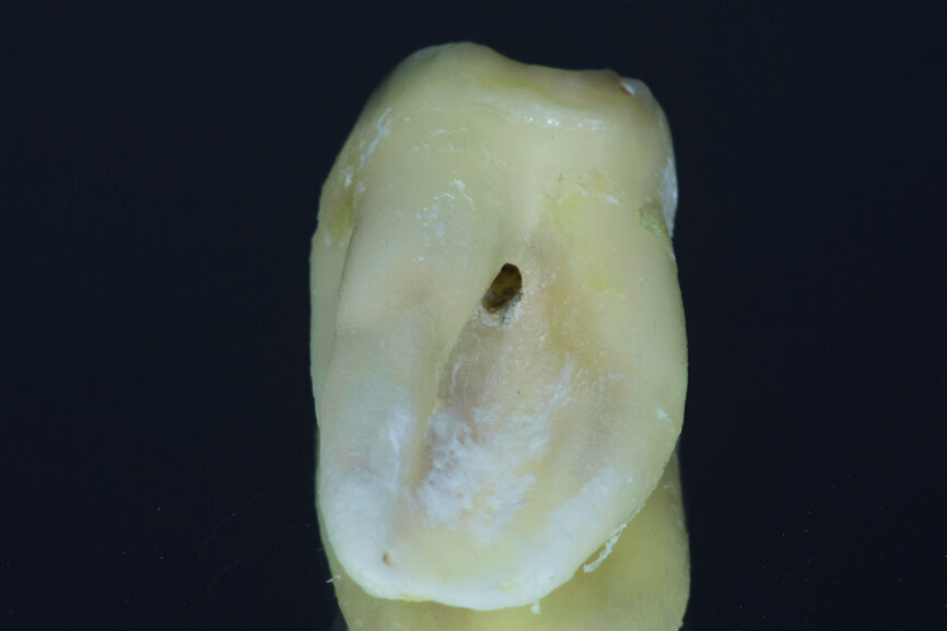 Fig. 13: Pulp chamber floor perforation, tooth cleaned.