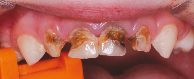 Poškozené horní řezáky