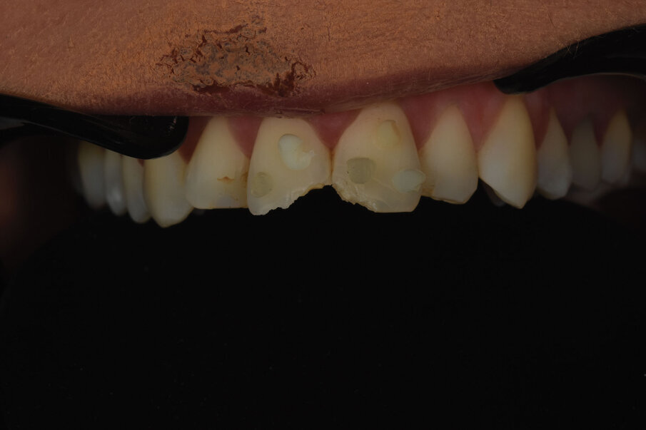 Sl. 4b: Polarizovana fotografija uz tzv. button tehniku (4b) i izrada individualnog ključa boja sa kompozitnim sistemom izbora adekvatan su način pravilnog odabira boje.