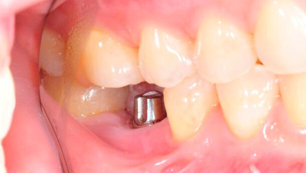 Oltre il 60 per cento dei dentisti esegue procedure di impianto dentale