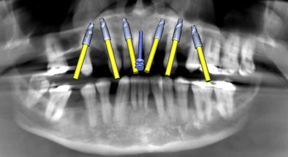 Fig. 2b: Maxillary implant simulation on the panoramic radiograph showing six implants and a nasopalatine canal pin.