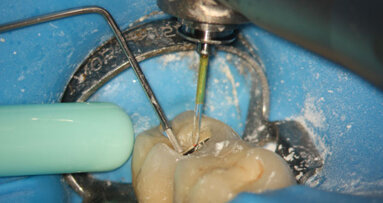 PIPS and retreatment