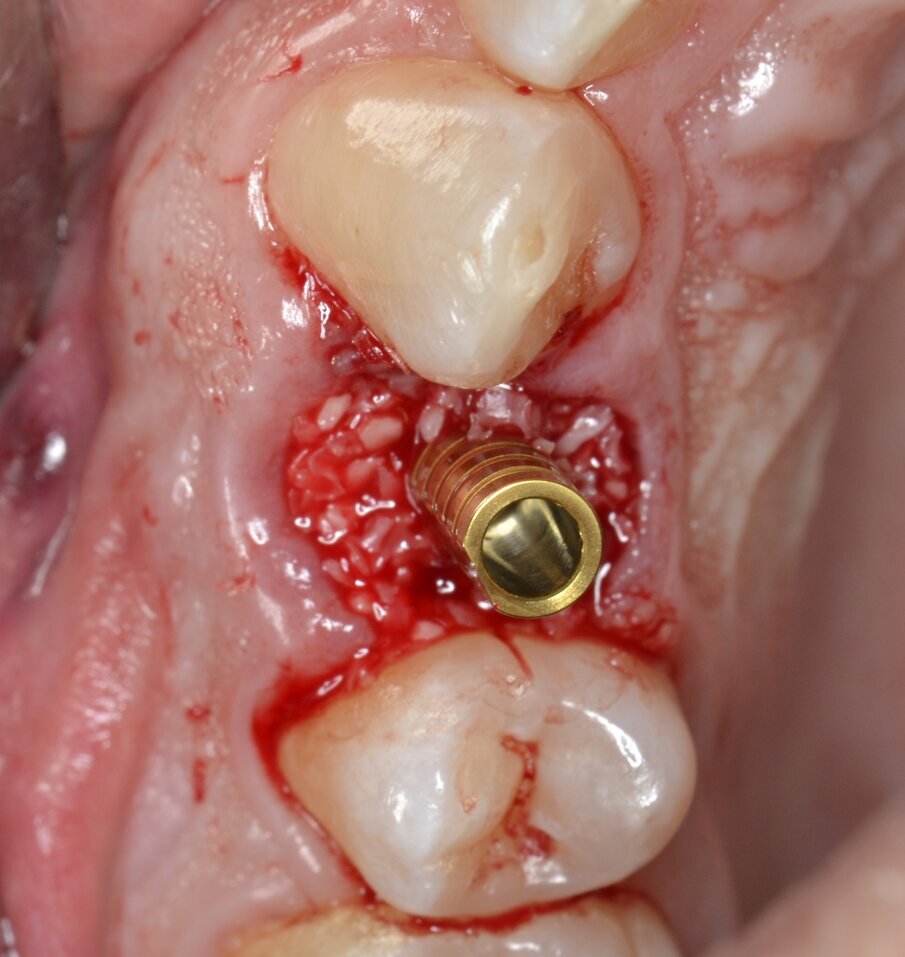 Fig. 13 - Innesto del gap peri-implantare con biomateriale eterologo.