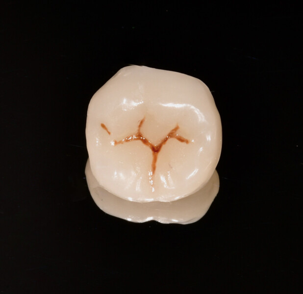 Fig. 8a: Milled resin composite endocrown after characterisation and polishing, occlusal surface.