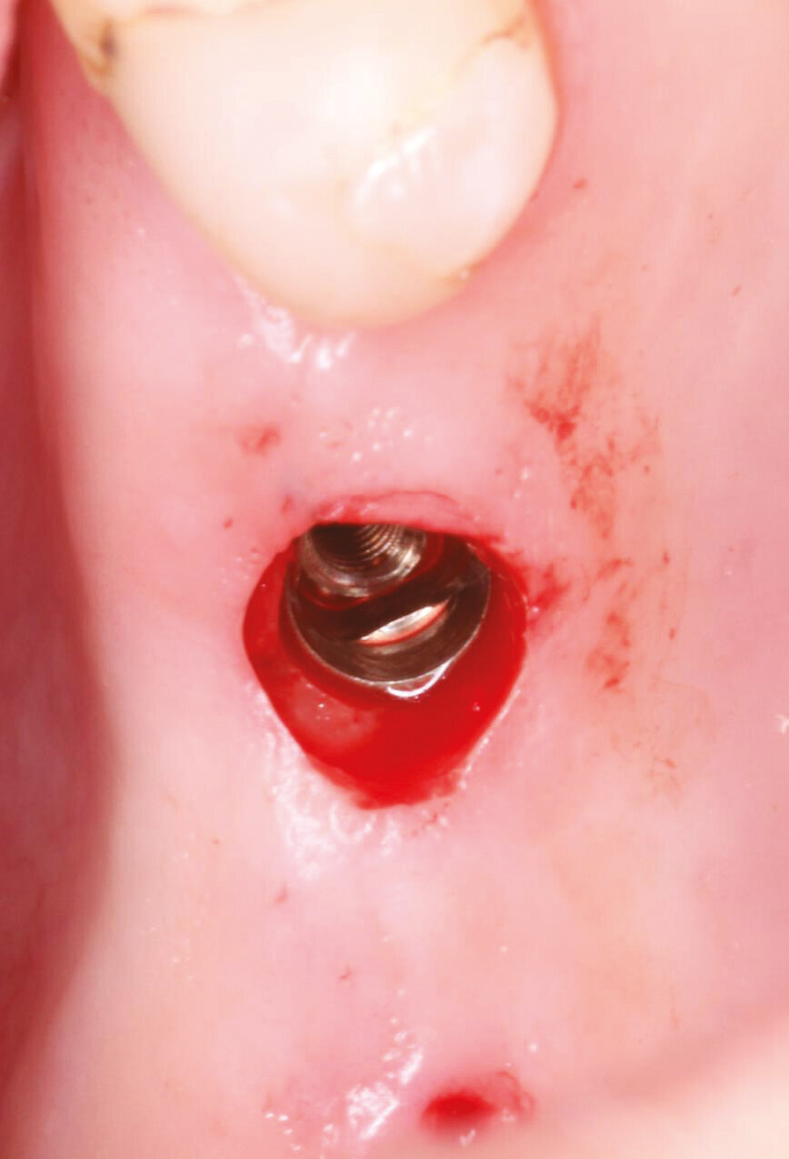 Fig.10: Axiom placement to 0,5 mm below crest of bone. 