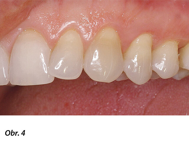 Zhojená a esteticky konsolidovaná oblast.