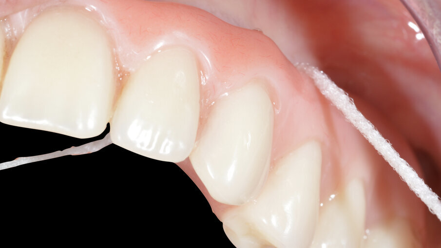 Fig. 16_Manovre di igiene domiciliare con superfloss.