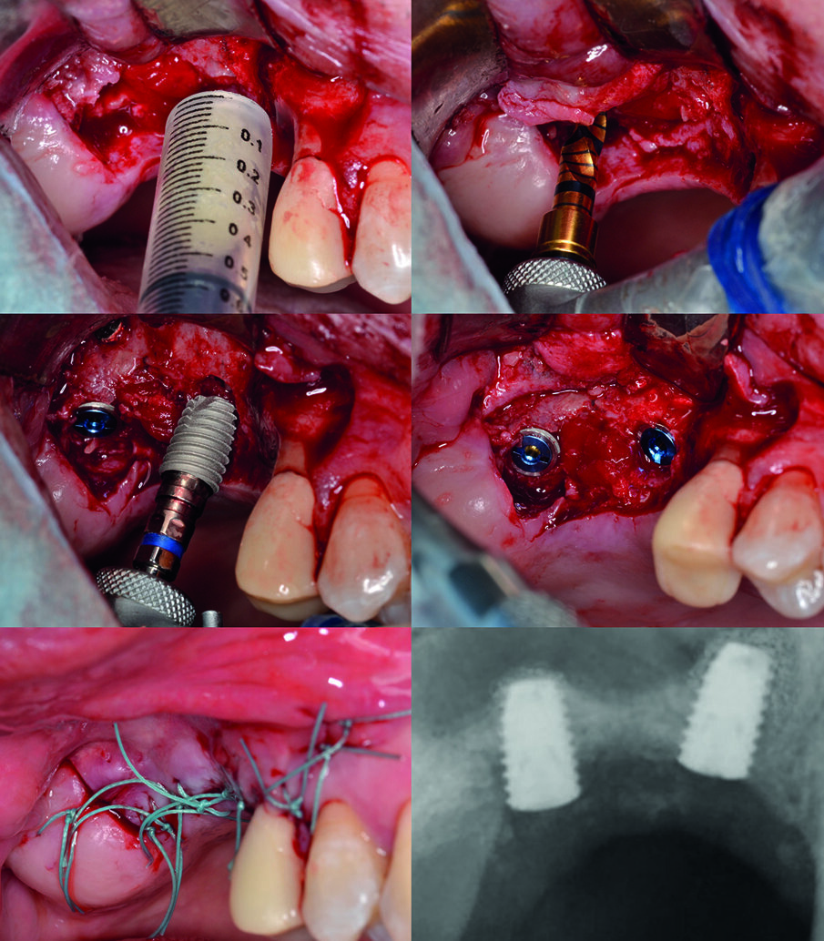 Fig. 3 - Innesto osseo e posizionamento degli impianti. La pasta ossea viene estrusa dalla siringa direttamente nei tunnel implantari; per favorire il riempimento dello spazio al di sotto della membrana, l’innesto è eseguito mediante apporti consecutivi di ridotta entità e, al termine, con l’ausilio di inserti tipo Rotary Plugger. Segue il posizionamento degli impianti e la sutura.