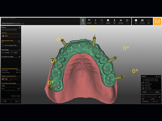 Použití kónických titanových základen našroubovaných přímo na náhradu bez abutmentu MUA není nejlepším řešením, protože otvory jsou vidět z vestibulární strany.