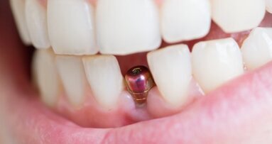 Conferência de Consenso Europeu libera atualização em implantes dentários