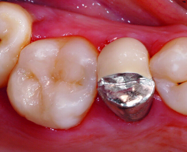 Fig.14 : Vue clinique post-opératoire après dépose du champ opératoire et réglage de l’occlusion