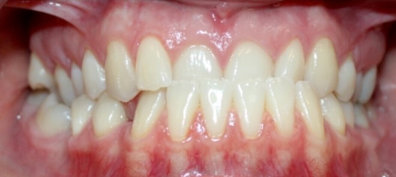Fig. 20a: Class III malocclusion requiring fixed appliance treatment. (a) Frontal view. (b) Occlusal view.