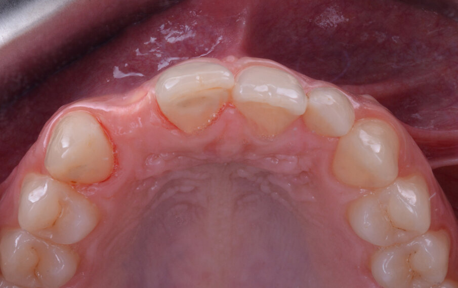 Fig. 4 - Situazione clinica iniziale (visione occlusale).