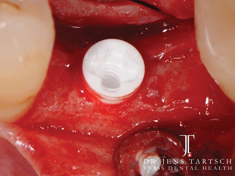 Fig. 5: Implant in situ; neck area 0.6 mm supracrestal. (Photo: Jens Tartsch, DMD)