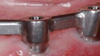 Leczenie bezzębia całkowitego – wskazaniem do zastosowania techniki CAD/CAM