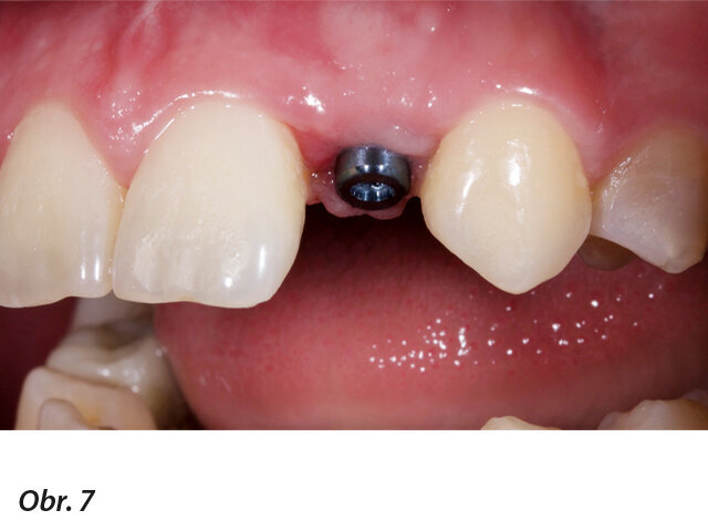 Obr. 6, 7: Úspěšné zavedení implantátu.