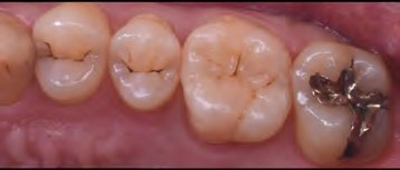  Fig. 3b: Postoperative view from the buccal aspect showing harmonious  integration of the restorations with the adjacent dentition. 