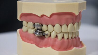 Debate por un dispositivo intraoral para perder peso