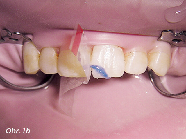 Obr. 1b, c: Po připojení obou fragmentů byl podél lomné linie vybroušen oblý schůdek, doplněn dalším kompozitem a zpolymerován na místě. To zvýší sílu spojení a lépe zakryje lomnou linii.