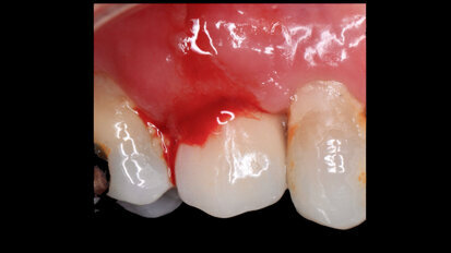 El enemigo invisible en la periimplantitis El enemigo invisible en la periimplantitis