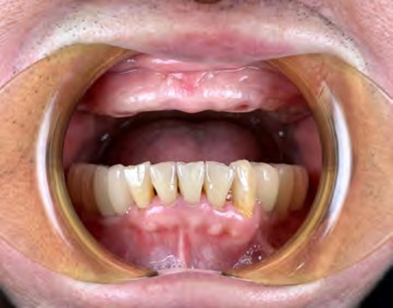 Fig. 5a: Pre-treatment smile view.