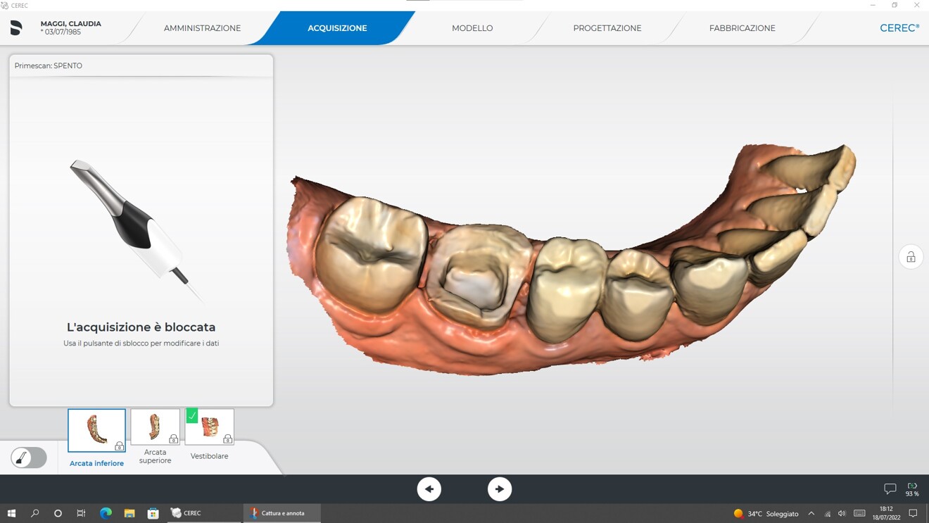 Fig. 4a: Digital impression workflow: intra-oral scan of the mandibular right quadrant with tooth #46 prepared.