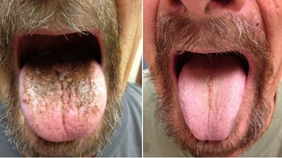 Антибиотици могат да предизвикат черен космат език