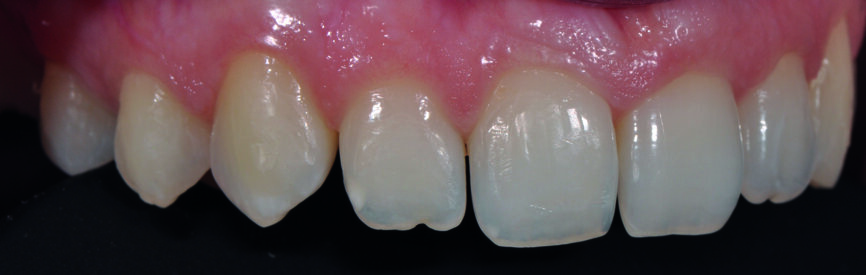 Fig 4b) :  vue intraorale latérale.  