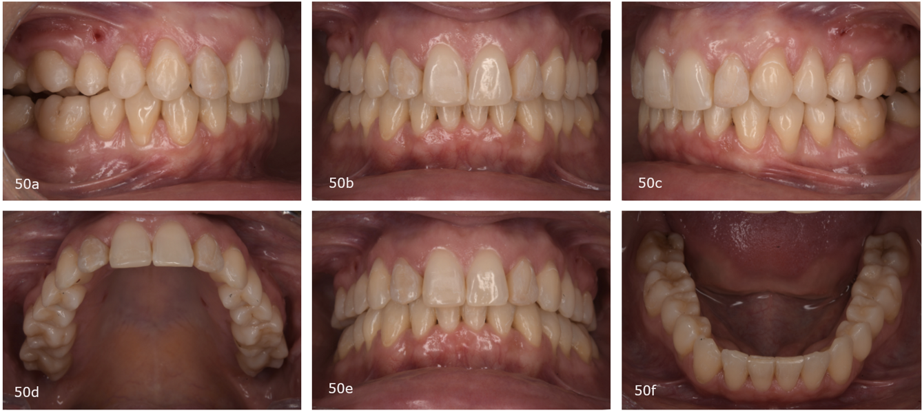 Figs. 50a–f: Situation after the second phase of aligner treatment.