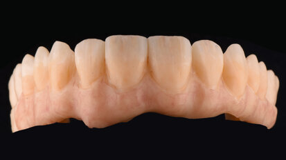 Micro‑layering for implant‑supported zirconia prostheses