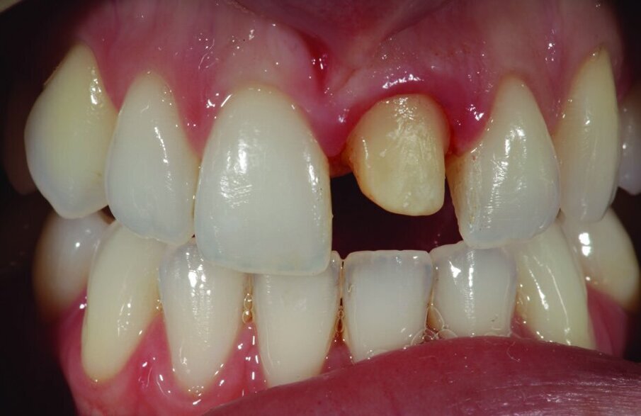 Fig. 2: The relatively dark tooth was prepared with a rounded shoulder.
