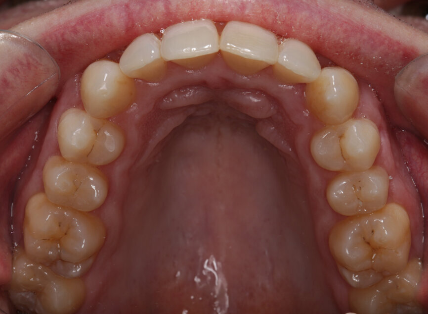 Fig. 17: Post-treatment upper occlusal view